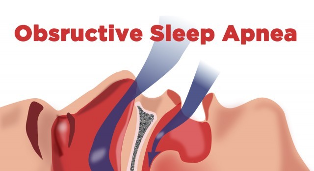 obstructive sleep apnea didgeridoo natural sleep apnea therapy