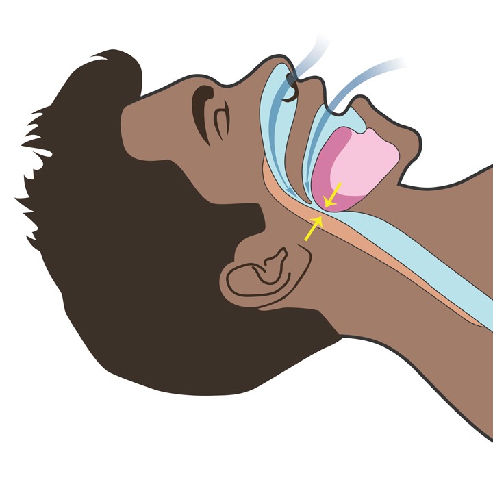 Compression of the airway during an apnea event.